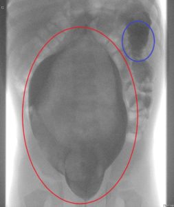 Morbus Hirschsprung: Mein Sohn hat diese seltene Erkrankung des Darms 3 Rönten Morbus Hirschsprung