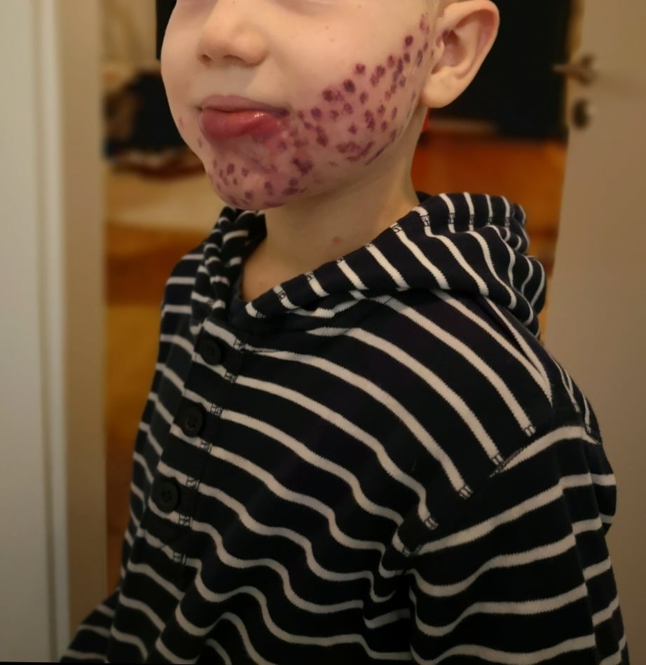 Mein Kind hat Feuermale im Gesicht & am Körper. Wie es ihm damit geht 2 Laserpunkte