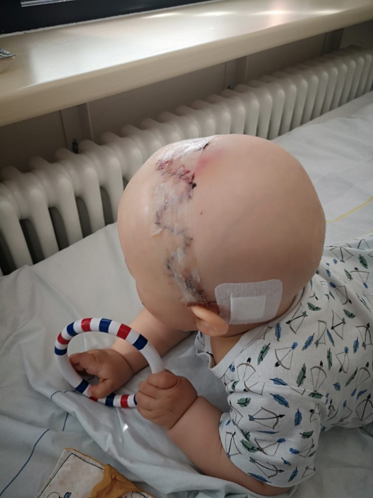 Kraniosynostose: Unser Kind kam mit einer Verknöcherung der Schädelnähte zur Welt 4 Kraniosynostose