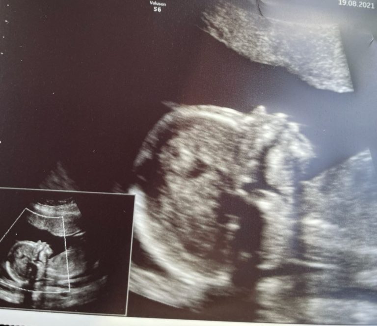 Fehldiagnose Fehlgeburt: Erst Trauer, dann ein schlagendes Herz 22 Schwangerschaftsabbruch