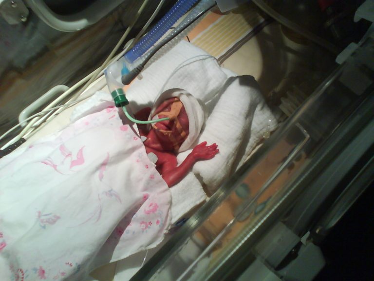 Welt-Frühgeborenen-Tag: "Unsere Tochter kam mit 605g in der 25. Woche zur Welt" 27 Welt-Frühgeborenen-Tag